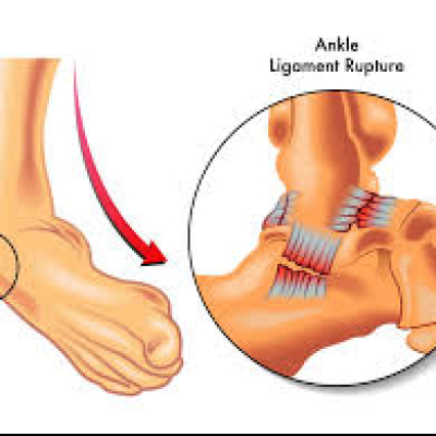 Ankle sprain
